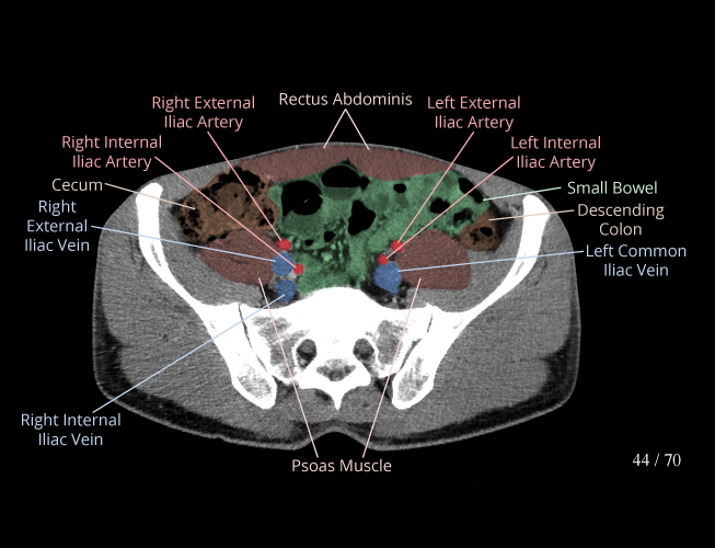 Ct Scan Of Abdomen: Stay Hydrated Before Exam