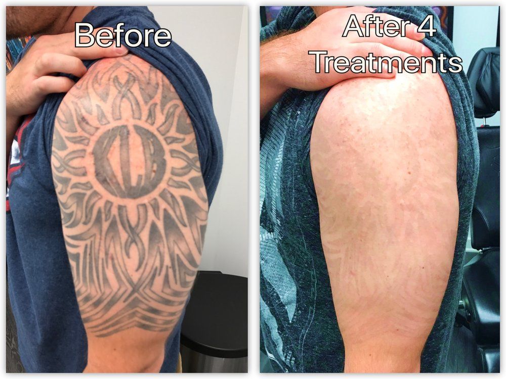 Tattoo Removal Before And After 2020 Tattoo Removal Cream Natural